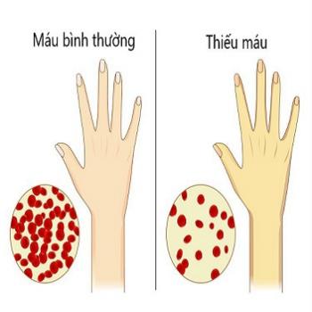 Dấu hiệu nhận biết người thiếu máu không nên bỏ qua